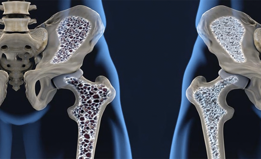 Entenda como o teste do calcâneo pode evitar ou reduzir danos da osteoporose - Reprodução