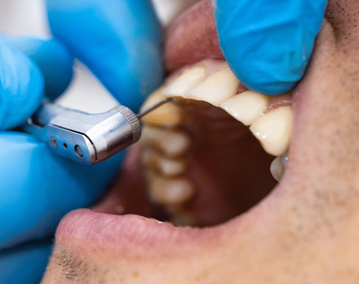 Câncer de Boca - Dentista cárie