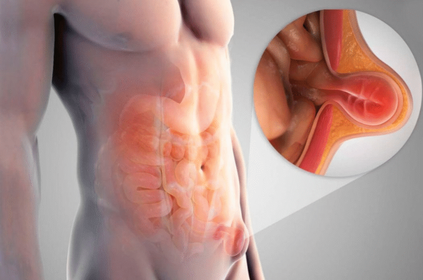 Hérnia Inguinal Bilateral - Cirurgia do Bolsonaro