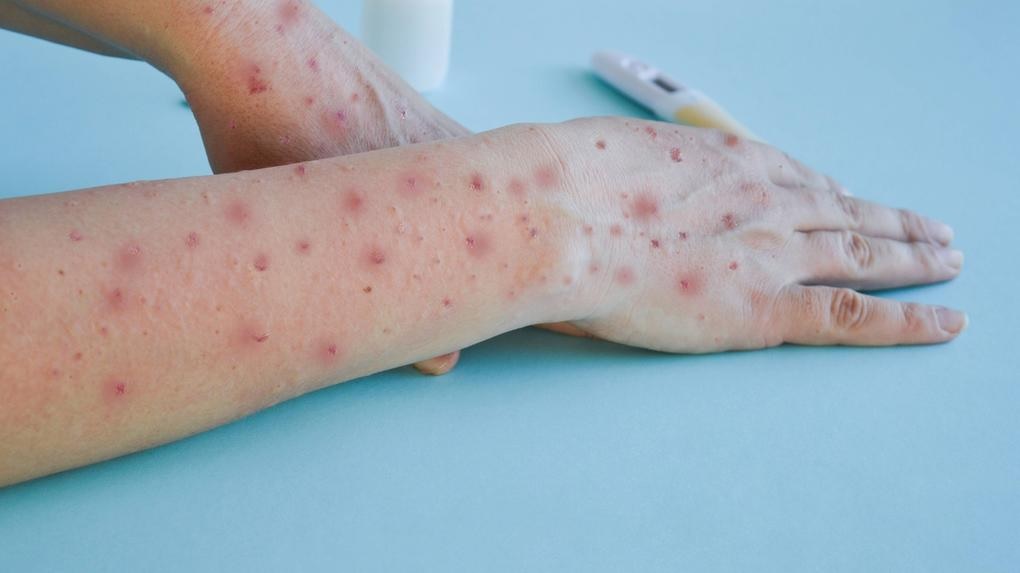 Mpox avança no Brasil, mas Baixada Santista segue sem novos casos